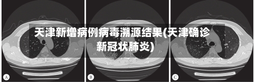 天津新增病例病毒溯源结果(天津确诊新冠状肺炎)